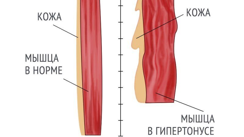 Пигментация над верхней губой .