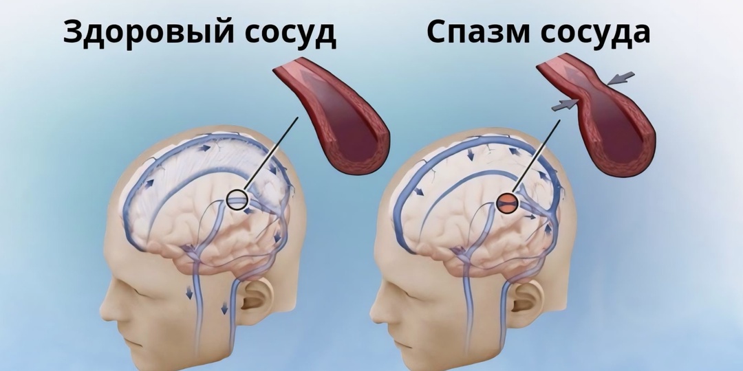 Как определить проблемы с сосудами на ранней стадии: 4 важных сигнала