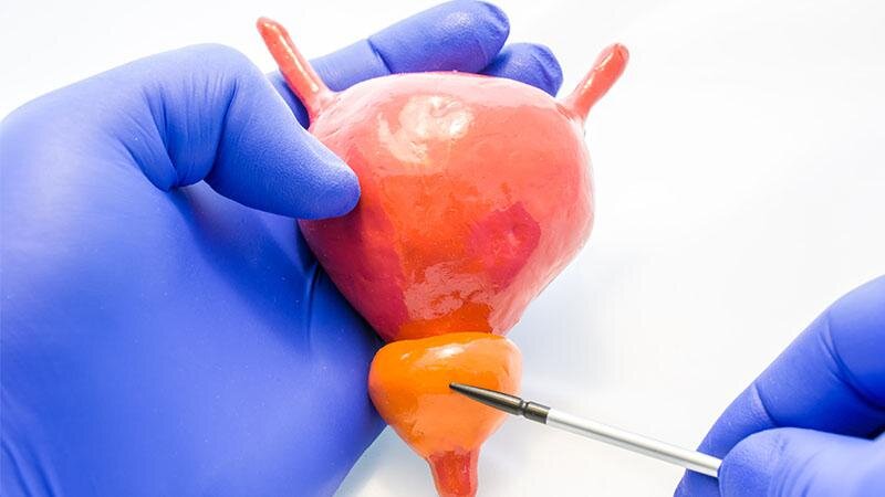 Простата окружает мочеиспускательный канал, поэтому заболевания данного органа могут привести к нарушению оттока мочи