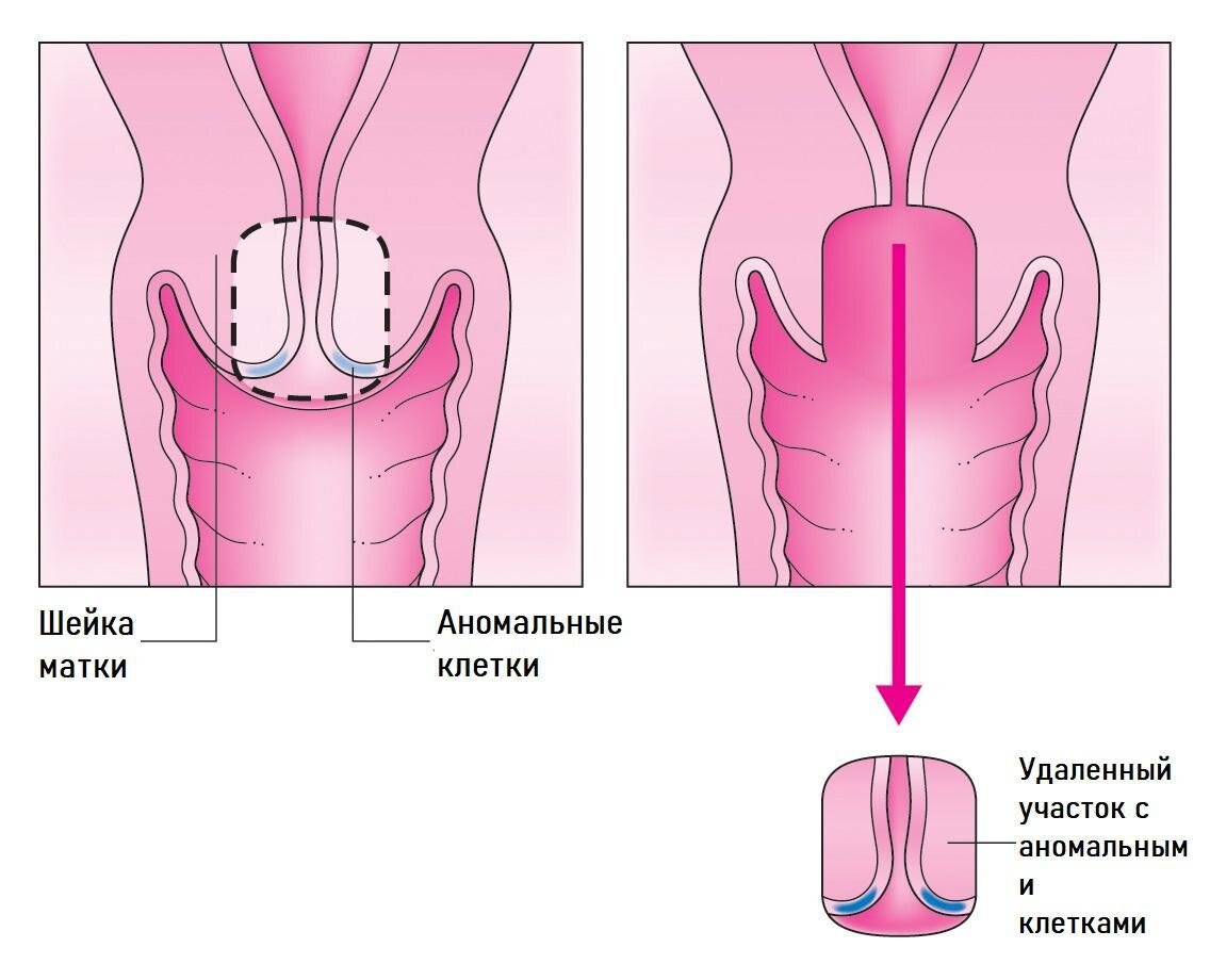 Конизация шейки матки | Ист Клиник | Дзен