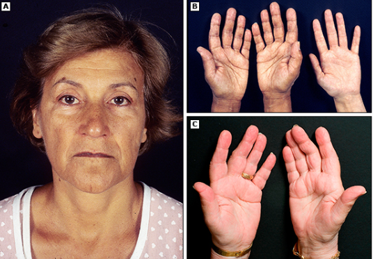 Гиперпигментация кожи лица и складок на ладонях - картинки A и B, изменение кожи после лечения глюкокортикостероидами и минералокортикоидами - картинка C.