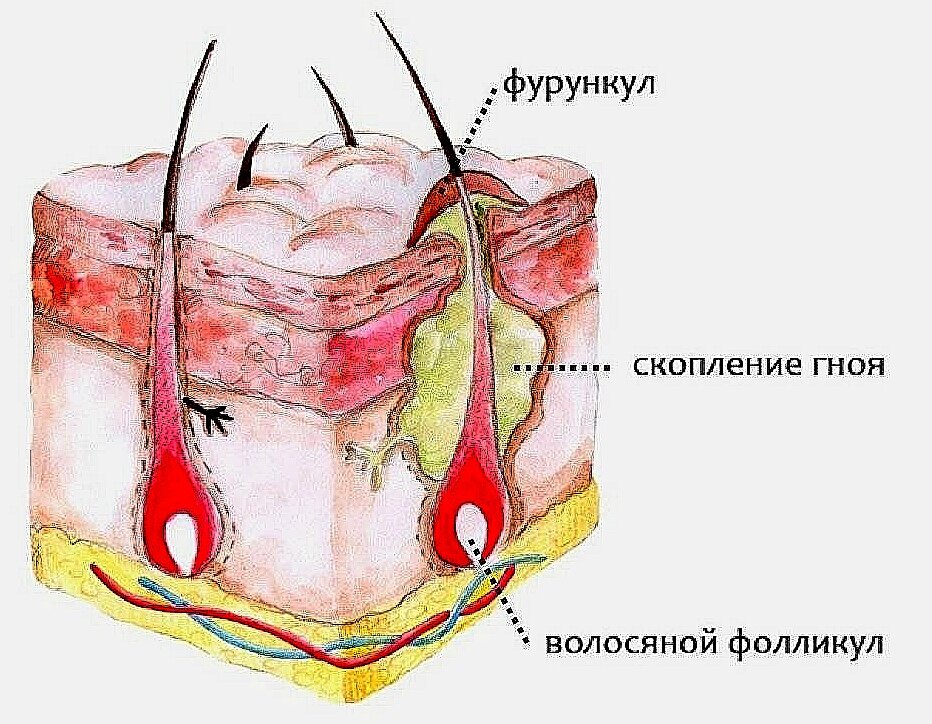 Стержень угря. Фурункул волосяного фолликула. Абсцедирование фурункула. Фурункулез волосяных фолликулов.