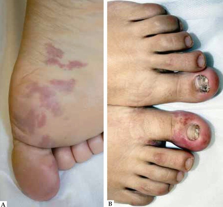 A. Клинические признаки. Пятна темно-красного цвета с пурпурными точечными вкраплениями на коже правой подошвы. B. Клинические особенности. Темно-красные точечные пятна, формирующие серпигинозные очертания на коже дорсальной поверхности первого пальца правой стопы. Первоисточник - Freites-Martinez A, Moreno-Torres A, Núñez AH, Martinez-Sanchez D, Huerta-Brogeras M, Borbujo J. Angioma serpiginosum: report of an unusual acral case and review of the literature. An Bras Dermatol. 2015 May-Jun;90(3 Suppl 1):26-8.  
Angioma serpiginosum: report of an unusual acral case and review of the literature - PMC (nih.gov)