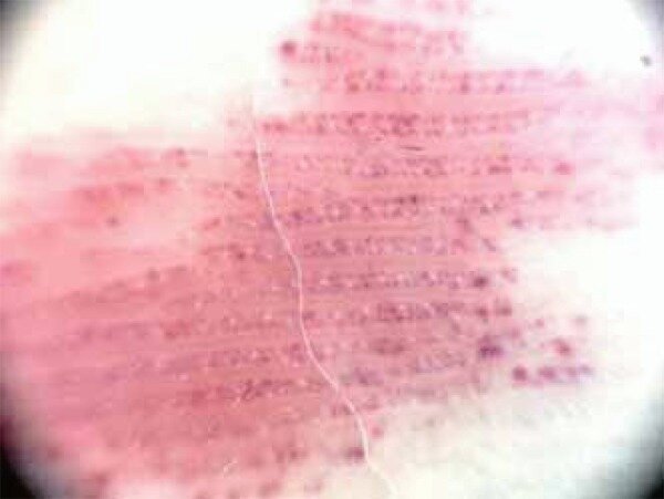 Дерматоскопия: модель строения в виде эритематозных параллельных полос в проекции гребней с нерегулярным распределением глобул. Красные полосы состоят из красноватых рядов точек и глобул, расположенных в виде двойной линии, отверстия протоков потовых желез не затронуты. Первоисточник - Freites-Martinez A, Moreno-Torres A, Núñez AH, Martinez-Sanchez D, Huerta-Brogeras M, Borbujo J. Angioma serpiginosum: report of an unusual acral case and review of the literature. An Bras Dermatol. 2015 May-Jun;90(3 Suppl 1):26-8.  
Angioma serpiginosum: report of an unusual acral case and review of the literature - PMC (nih.gov)