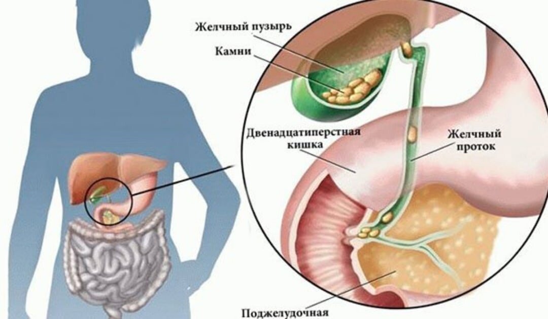 Чувствую желчный пузырь. Желчного пузыря камни желчном пузыре. Конкременты желчного пузыря что это такое.