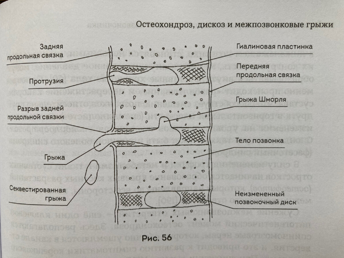 Протрузия и грыжа диска поясничного отдела позвоночника