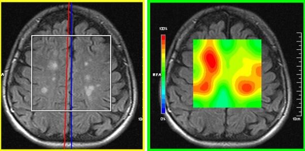 Мрт диагностика рассеянного склероза