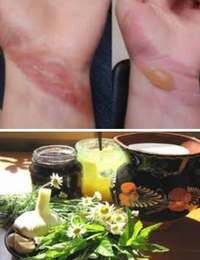 народные рецепты от ожогов, ран, ушибов