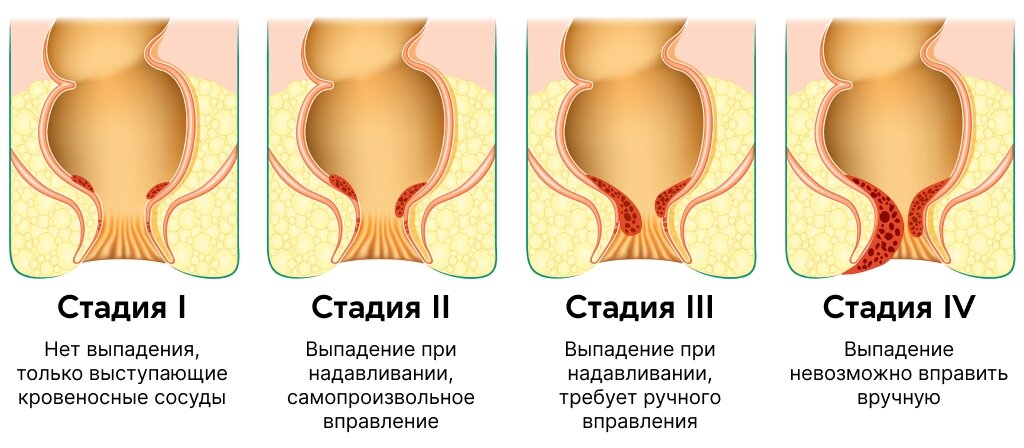 Профилактика геморроя