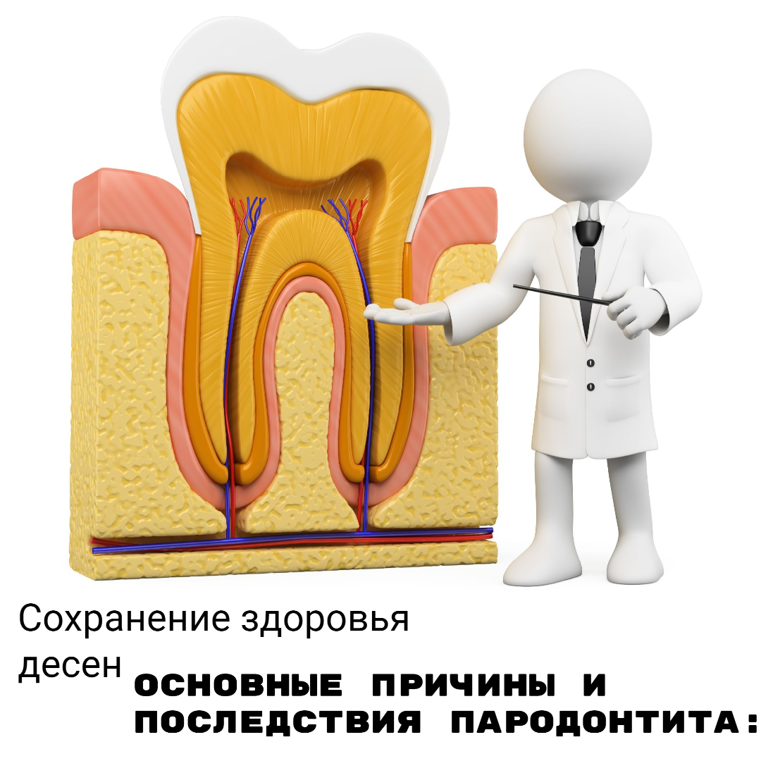 🆘Что это такое? Пародонтит — это инфекционное воспалительное заболевание  десны и околозубных тканей. Как правило, проявляется на фоне |  bobrovclinic.ru | Дзен