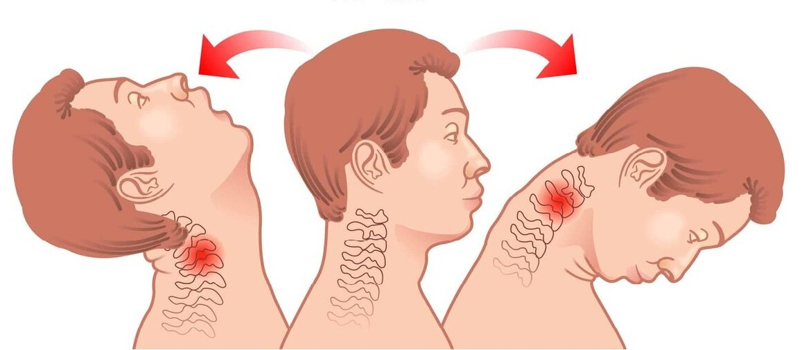  В этой статье представлены пять распространенных причин болей в шее и их лечение, а также общие симптомы, которые помогут их идентифицировать. 1.-6
