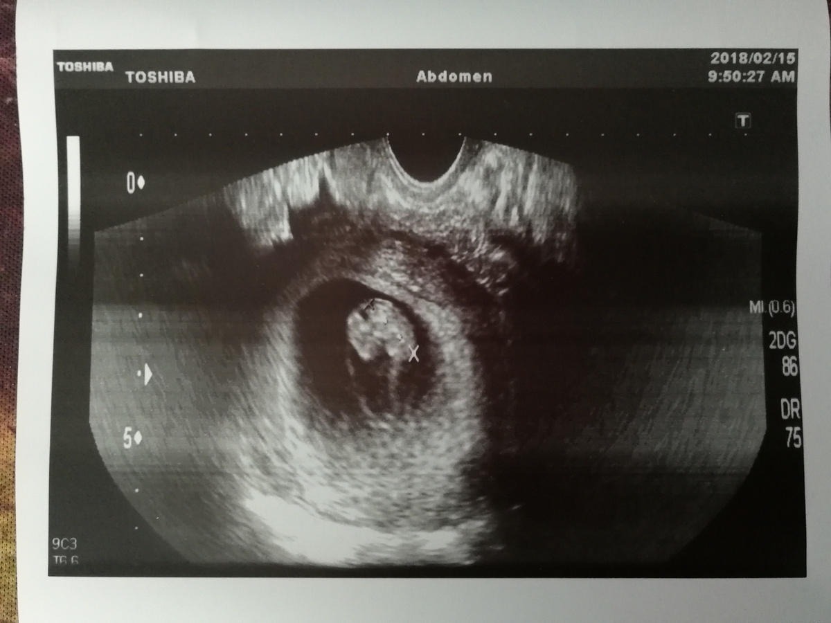 7 недель беременности. Видно уже нашу "креветочку"