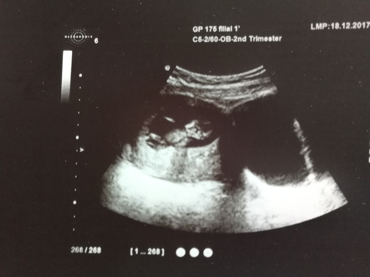 11 недель беременности. А тут уже полноценный человечек! 