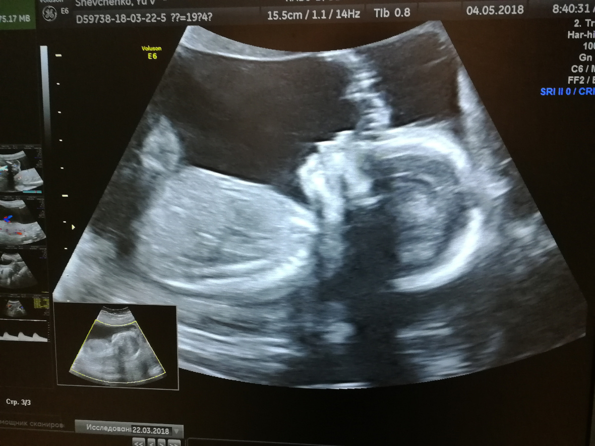 19 недель беременности. 2-й скрининг