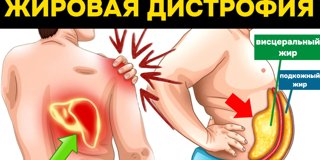 9 признаков жировой дистрофии печени, на которые стоит обратить внимание