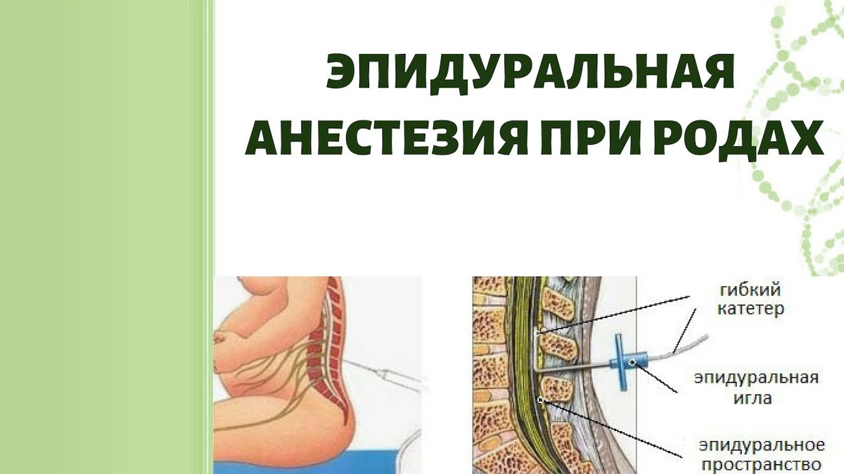 14 вопросов об эпидуральной анестезии при родах: все, что вы хотели знать о  обезболивании | О детском здоровье: с врачебного на родительский | Дзен