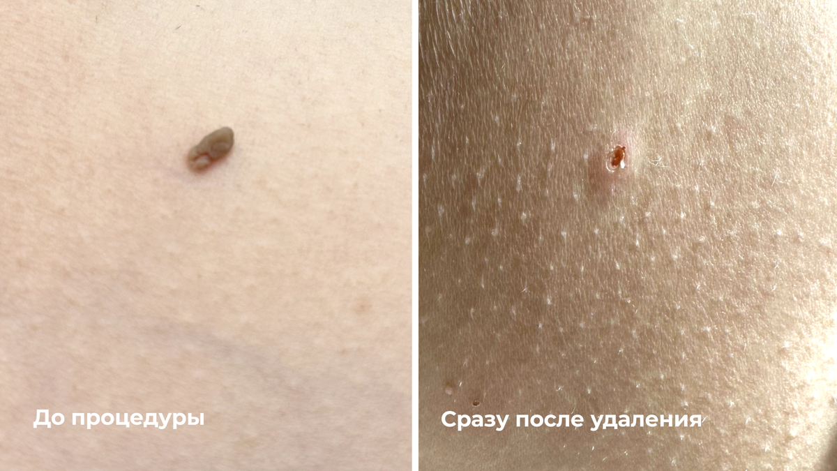 Удаление папилломы в подмышечной области: до и сразу после