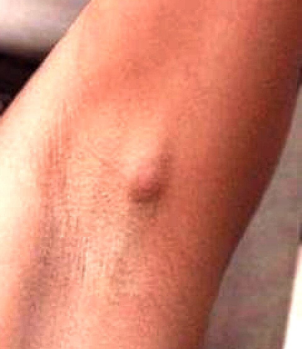 Гидраденит в стадии инфильтрации. 