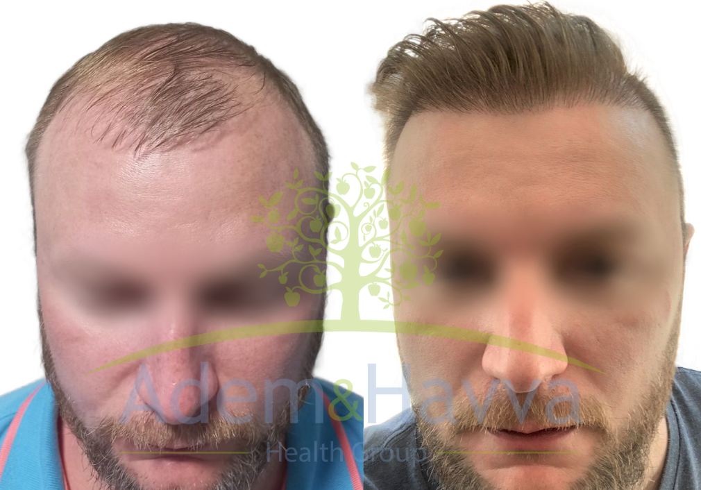 Органическая трансплантация волос в Турции 