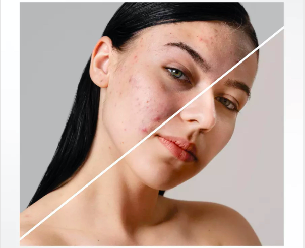 бороться с высыпаниями с помощью натуральной косметики на основе целебной грязи Сакского озера и гидролата розы 