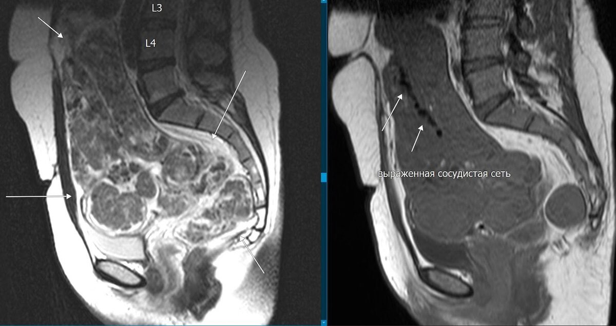 Рис.1. Образование, занимающее всю полость малого таза, наличие сосудистой сети.