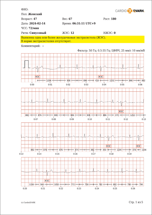 ЭКГ при желудочковой экстрасистолии. КардиоКАРТА.