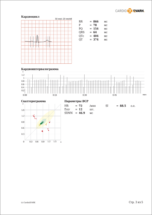 ЭКГ при желудочковой экстрасистолии. КардиоКАРТА.