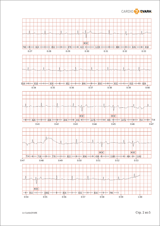 ЭКГ при желудочковой экстрасистолии. КардиоКАРТА.