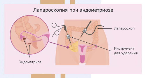 Лапароскопия при эндометриозе