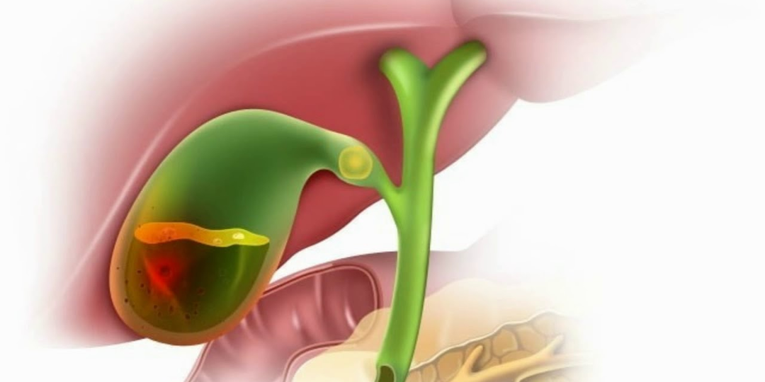 Холецистит? Без камней? Да, так тоже бывает – в чем причина воспаления желчного пузыря