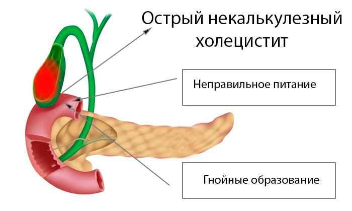 Стул при холецистите хроническом холецистите