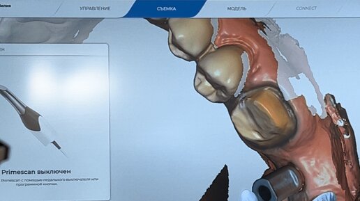 3D Сканирование зубов