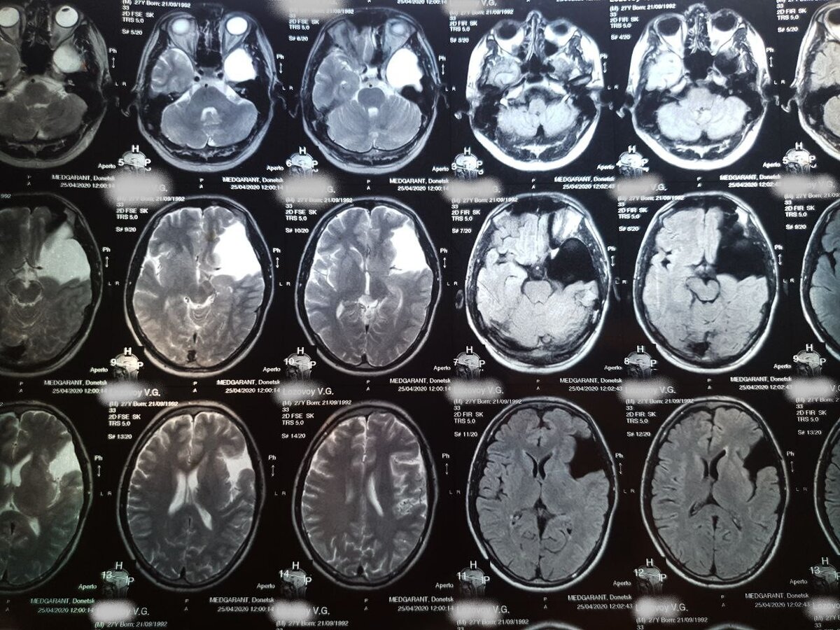 Мой снимок МРТ, наблюдаюсь с 2012 года. Арахноидальная киста размерами 6х6х5,5 сантиметров.