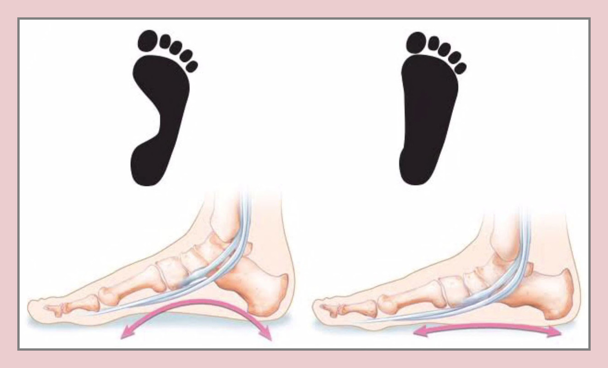 Гипорефлексия мышц ног при плоскостопии | Сам Себе Ортопед. Спб. | Дзен