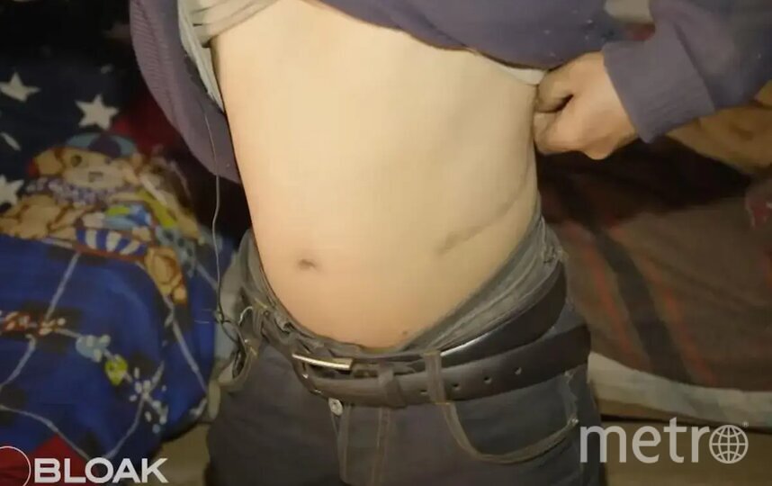    Шрам от изъятия почки.Скриншот Youtube-канала Rebloak