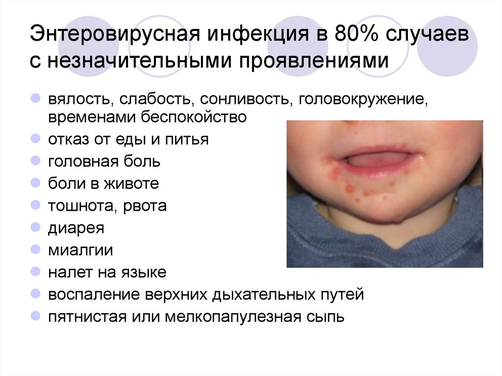 Энтеровирус c. Энтеровирусная инфекция экзантема. Энтеровирусная сыпь у детей.