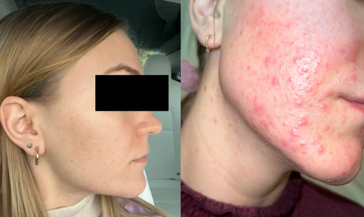 Так выглядит кожа до (слева) и после (справа) химического пилинга у косметолога спустя три недели после процедуры. Отсутствие защиты кожного барьера после процедуры может привести к бактериальному заражению и длительному восстановлению.