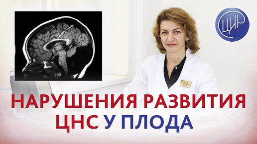 Пороки развития головного мозга. Было 2 беременности с синдромом Денди Уокера. Что делать?