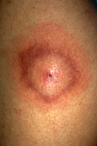 Мигрирующая эритема