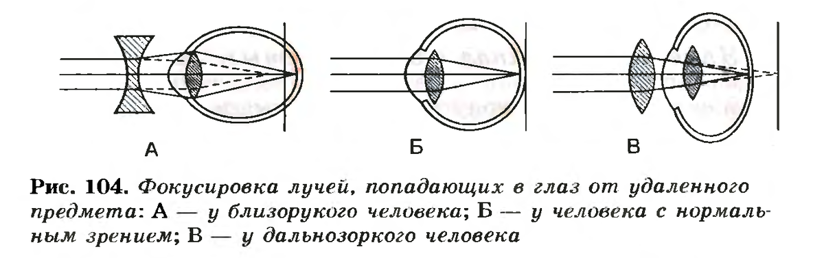 Что такое миопия, пресбиопия и лазерная коррекция