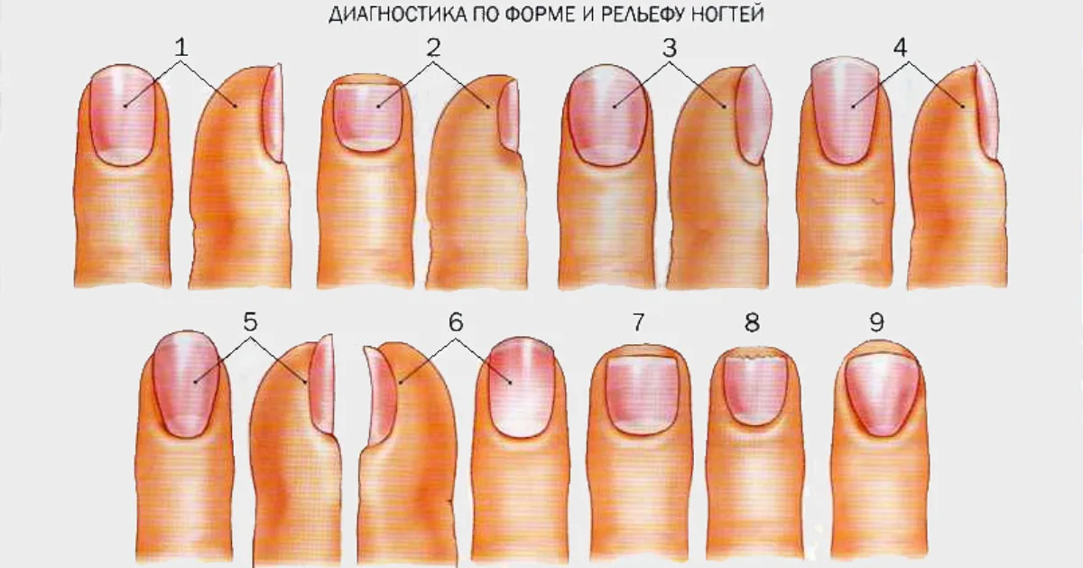 Ногти являются придатками кожи и их патологические изменения и болезни могут быть симптомом многих заболеваний организма. При некоторых заболеваниях могут возникать сходные проявления поражения ногтей.