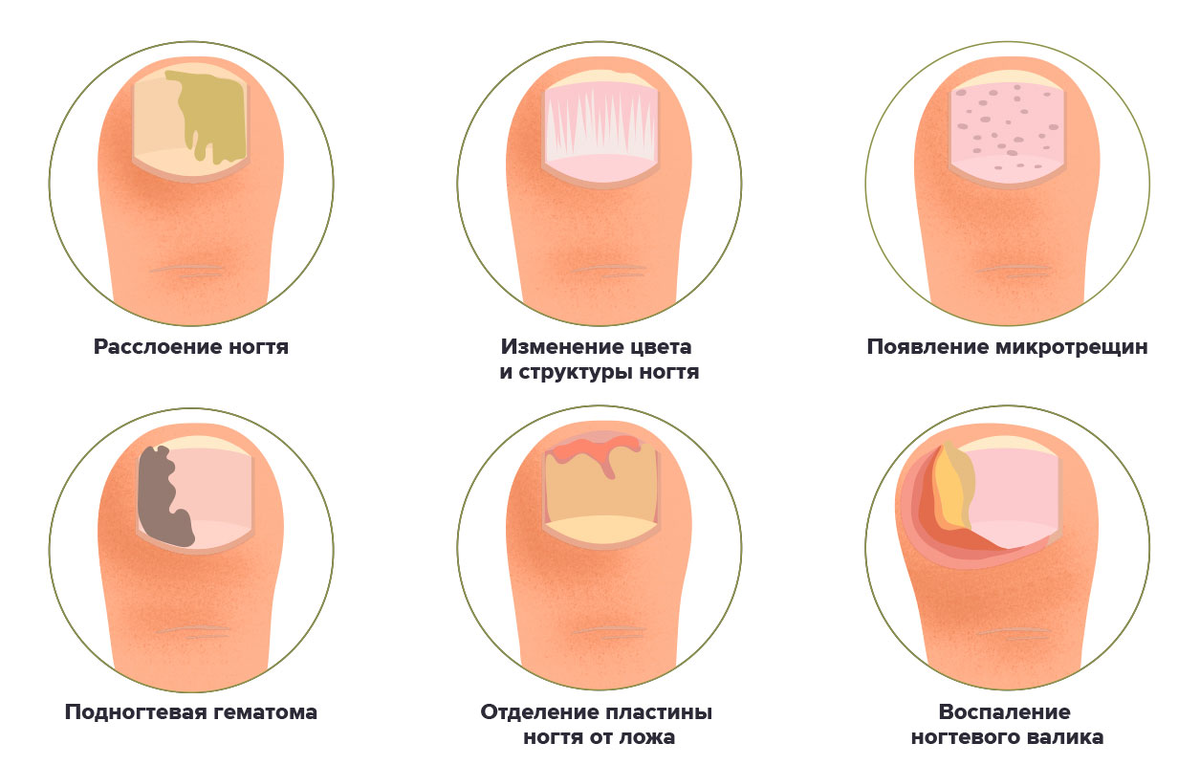Грибок ногтей как снять Посмотрите на свои ногти: вот что можно по их изменениям сказать о вашем здоровь
