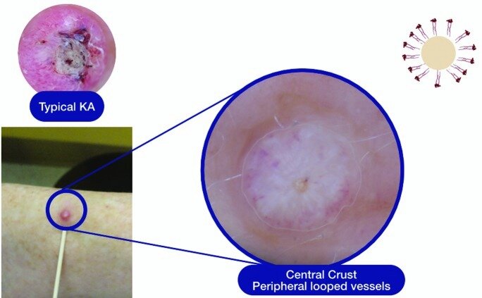 Пациент №1. Клинические и дерматоскопические признаки кератоакантомы с корочкой в центре, имитирующей таковую при акне, в сравнении с типичной кератоанкантомой с центральной кератиновой коркой и периферическими петлеобразными сосудами. Схематическое изображение периферических петлеобразных сосудов справа вверху. Первоисточник - Markowitz O, Utz S. Differentiating Early Stage Cystic Keratoacanthoma, Nodular Basal Cell Carcinoma, and Excoriated Acne Vulgaris by Clinical Exam, Dermoscopy, and Optical Coherence Tomography: A Report of 3 Cases. J Clin Aesthet Dermatol. 2015 Apr;8(4):48-50. 
Differentiating Early Stage Cystic Keratoacanthoma, Nodular Basal Cell Carcinoma, and Excoriated Acne Vulgaris by Clinical Exam, Dermoscopy, and Optical Coherence Tomography: A Report of 3 Cases - PMC (nih.gov)