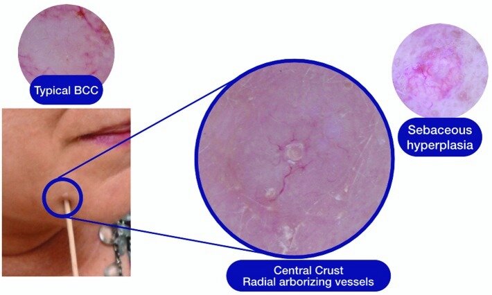Пациент №2: Клинические и дерматоскопические признаки узловой формы БКК с центральной точечной корочкой и радиально ориентированными тонкими древовидными сосудами в сравнении с типичными сосудами БКК, пересекающими центральную часть. Периферические радиально ориентированные короновидные сосуды наблюдаются при гиперплазии сальных желез.  Первоисточник - Markowitz O, Utz S. Differentiating Early Stage Cystic Keratoacanthoma, Nodular Basal Cell Carcinoma, and Excoriated Acne Vulgaris by Clinical Exam, Dermoscopy, and Optical Coherence Tomography: A Report of 3 Cases. J Clin Aesthet Dermatol. 2015 Apr;8(4):48-50. 
Differentiating Early Stage Cystic Keratoacanthoma, Nodular Basal Cell Carcinoma, and Excoriated Acne Vulgaris by Clinical Exam, Dermoscopy, and Optical Coherence Tomography: A Report of 3 Cases - PMC (nih.gov)