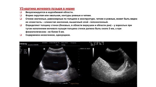 Ультразвуковая диагностика (УЗИ). Доктор Иогансен. Выпуск 94. Методика УЗИ мочевого пузыря.