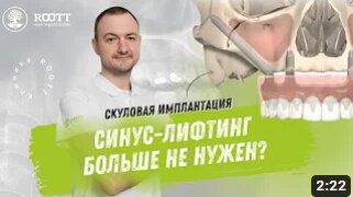 Скуловая имплантация зубов: что это?