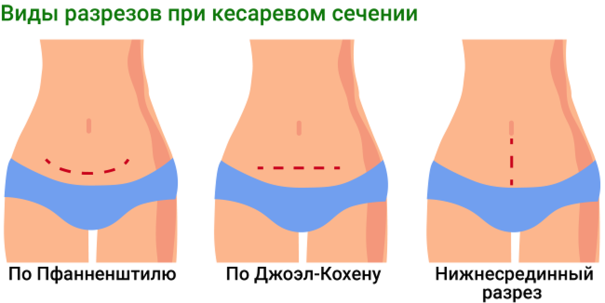 Поперечный разрез кесарево. Разрез при кесарево сечение. Типы разрезов при кесаревом сечении. Виды разрезов при кесарева се. Виды разрезом при кесарево сечееие.