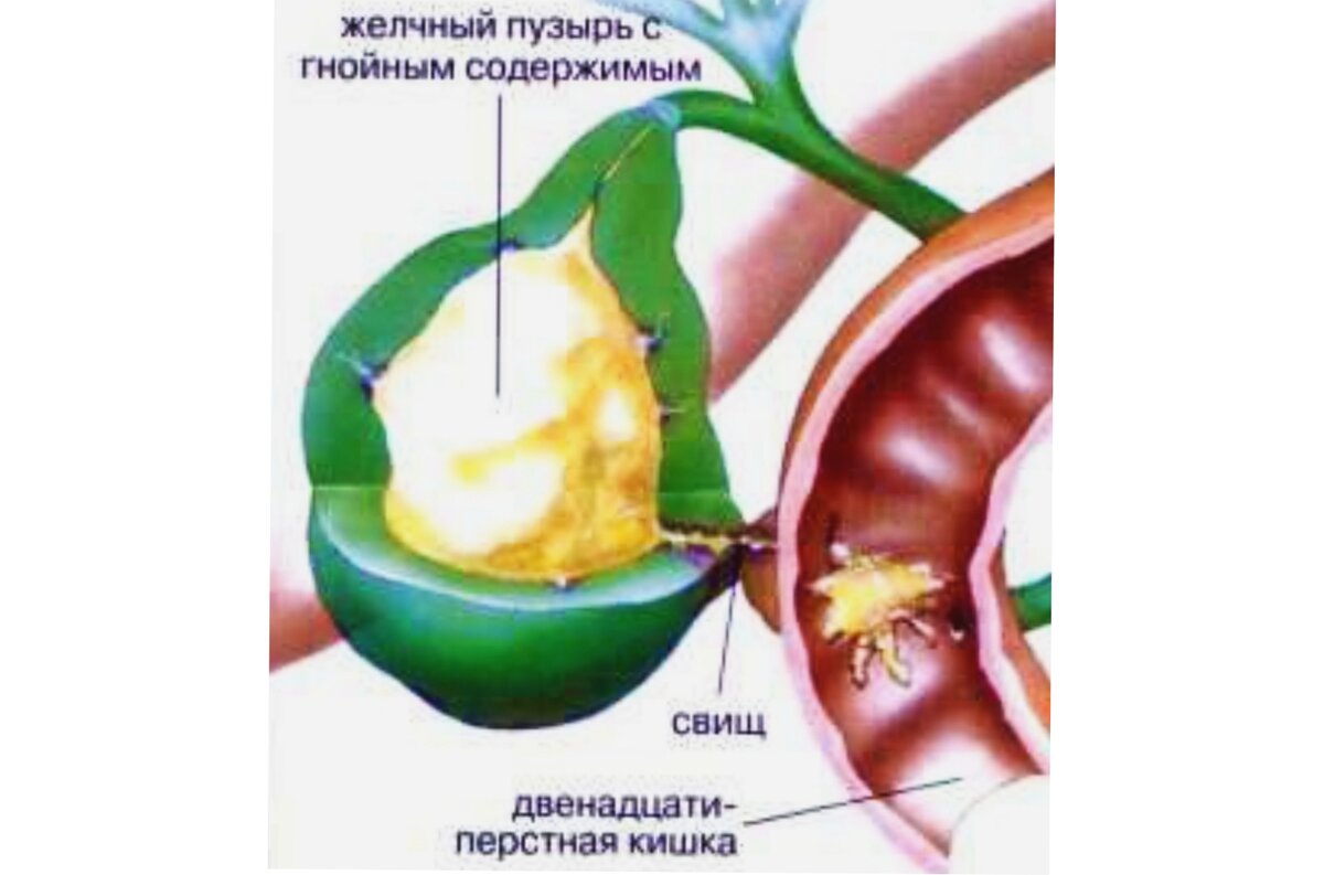 Разрыв желчного симптомы. Гнойный холецистит желчного пузыря. Эмпиема желчного пузыря. Перфорация стенки желчного пузыря. Хроническая эмпиема желчного пузыря.