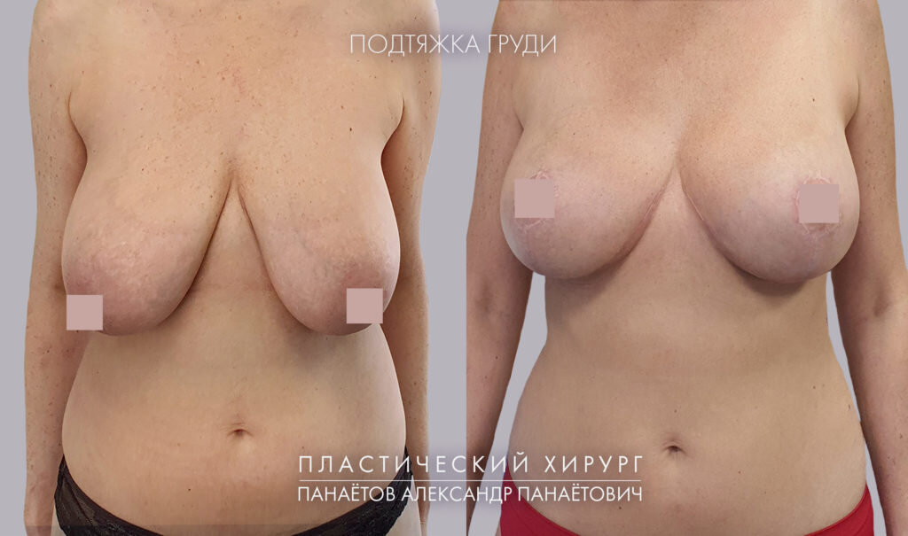 Подтяжка груди. Работа А.П.Панаетова