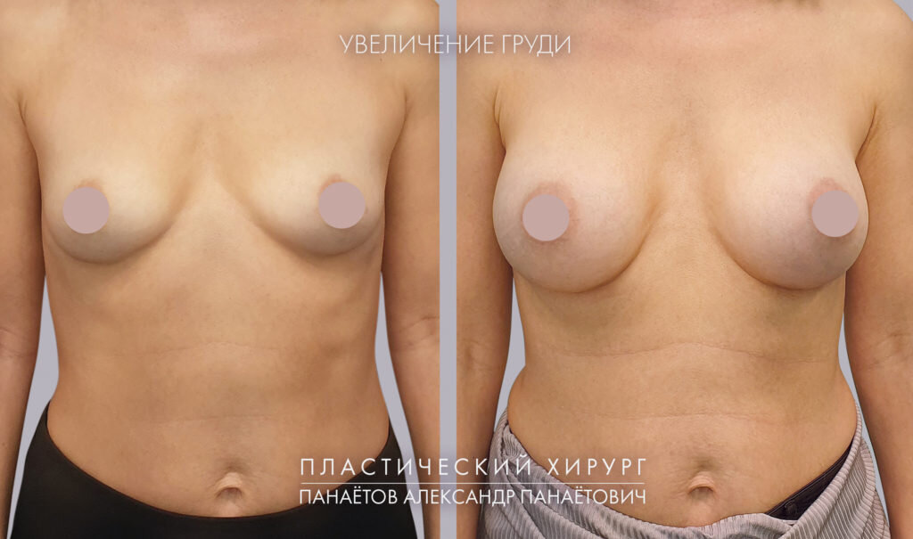 Увеличивающая маммопластика. Работа А.П.Панаетова